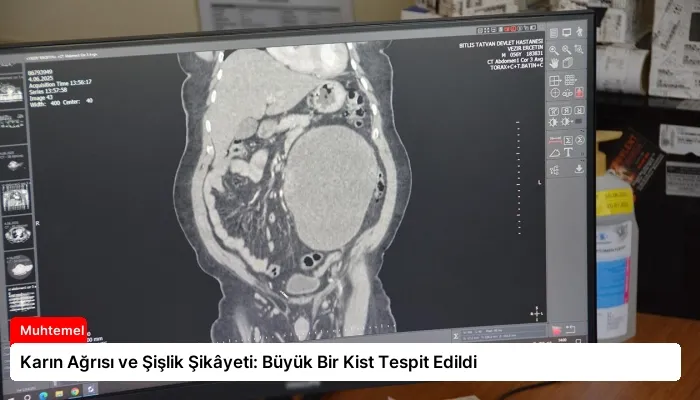 Karın Ağrısı ve Şişlik Şikâyeti: Büyük Bir Kist Tespit Edildi