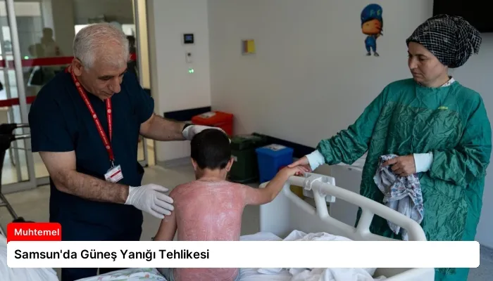 Samsun’da Güneş Yanığı Tehlikesi