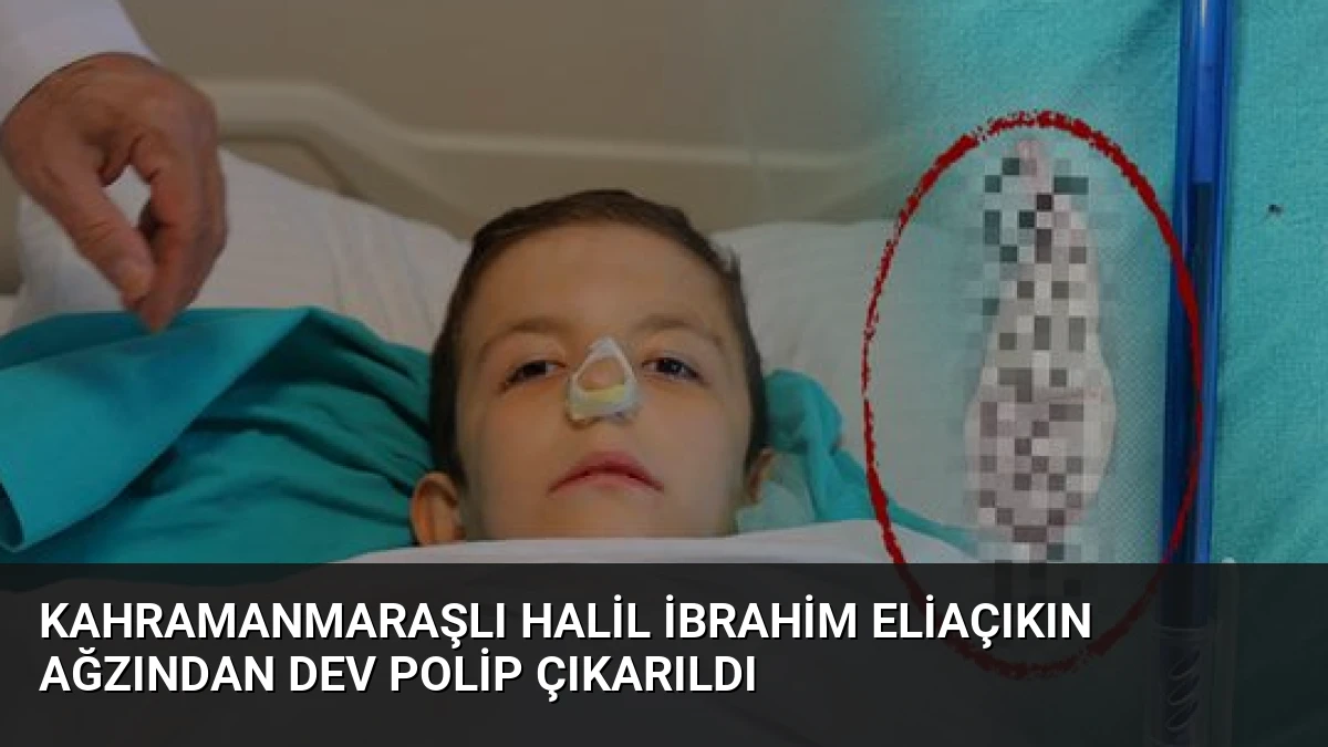 Kahramanmaraşlı Halil İbrahim Eliaçıkın Ağzından Dev Polip Çıkarıldı