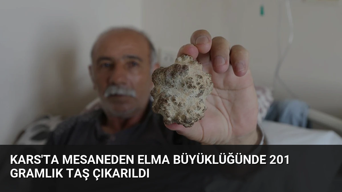 Kars’ta Mesaneden Elma Büyüklüğünde 201 Gramlık Taş Çıkarıldı